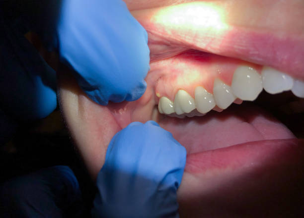Best Emergency Dental Care for Sports Injuries in Rural Hill, TN